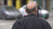 New study explains how a high fat diet can increase hair loss