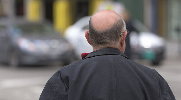 New study explains how a high fat diet can increase hair loss